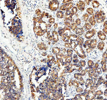 Immunohistochemical staining of FFPE human breast cancer tissue with ECE1 antibody, HRP-secondary and DAB substrate. HIER: boil tissue sections in pH8 EDTA for 20 min and allow to cool before testing.