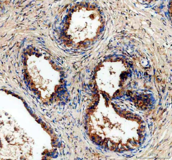 ALDH1A3 Antibody Prostate Cancer IHC. Immunohistochemistry staining of FFPE human prostate cancer tissue using ALDH1A3 antibody with HRP-secondary and DAB chromogen demonstrates strong cytoplasmic staining within neoplastic glandular epithelial cells, consistent with expression of Aldehyde Dehydrogenase 1 Family Member A3 (ALDH1A3). Also known as retinaldehyde dehydrogenase 3 (RALDH3), ALDH1A3 is an NAD-dependent enzyme involved in retinoic acid synthesis and regulation of cellular differentiation pathways. The observed staining pattern is consistent with the established role of ALDH1A3 in retinoid metabolism, tissue homeostasis, and cancer-associated cellular plasticity. These findings support the utility of ALDH1A3 antibody for studies of tumor biology, stem cell-associated pathways, and differentiation-related signaling mechanisms. HIER: boil tissue sections in pH 8 EDTA for 20 min and allow to cool before testing.