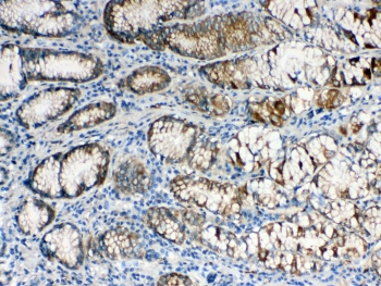 ALDH1A3 Antibody Stomach Cancer IHC. Immunohistochemistry staining of FFPE human stomach cancer tissue using ALDH1A3 antibody demonstrates moderate to strong cytoplasmic staining within neoplastic glandular epithelial cells, consistent with expression of Aldehyde Dehydrogenase 1 Family Member A3 (ALDH1A3). Also known as retinaldehyde dehydrogenase 3 (RALDH3), ALDH1A3 is an NAD-dependent enzyme involved in retinoic acid synthesis and regulation of cellular differentiation pathways. The observed staining pattern is consistent with the role of ALDH1A3 in retinoid metabolism, tissue homeostasis, and cancer-associated cellular plasticity. These findings support the utility of ALDH1A3 antibody for studies of tumor biology, stem cell-associated pathways, and differentiation-related signaling mechanisms. Required HIER: steam section in pH6 citrate buffer for 20 min and allow to cool prior to testing.
