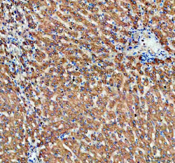 ALDH1A3 Antibody Human Liver IHC. Immunohistochemistry staining of FFPE human liver tissue using ALDH1A3 antibody with HRP-secondary and DAB chromogen demonstrates strong diffuse cytoplasmic staining throughout hepatocyte populations, consistent with expression of Aldehyde Dehydrogenase 1 Family Member A3 (ALDH1A3). Also known as retinaldehyde dehydrogenase 3 (RALDH3), ALDH1A3 is an NAD-dependent enzyme responsible for the conversion of retinaldehyde to retinoic acid, thereby regulating retinoid metabolism and differentiation-associated signaling pathways. The observed staining pattern is consistent with the metabolic and homeostatic functions of ALDH1A3 in hepatic tissue and supports the utility of this antibody for studies of retinoic acid biology, tissue differentiation, and cancer-associated cellular plasticity. HIER: boil tissue sections in pH 8 EDTA for 20 min and allow to cool before testing.