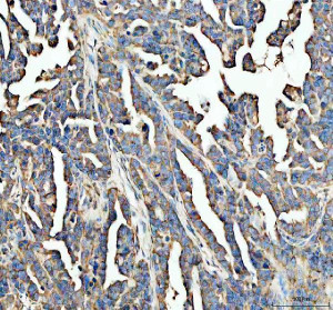 CD151 Antibody Human Ovarian Cancer IHC. Immunohistochemical staining of FFPE human ovarian cancer tissue using CD151 Antibody following heat-induced epitope retrieval in pH8 EDTA buffer. The tissue was incubated with the primary antibody at 2 ug/ml and detected using an HRP-conjugated secondary antibody with DAB chromogen. CD151 immunoreactivity is observed predominantly along the cell membrane with additional cytoplasmic staining in the neoplastic epithelial cells, consistent with the known localization of this tetraspanin family member. These findings demonstrate that this CD151 Antibody, a Tetraspanin Cell Adhesion Protein Antibody, is suitable for immunohistochemical detection of endogenous CD151 in FFPE human ovarian cancer tissue.