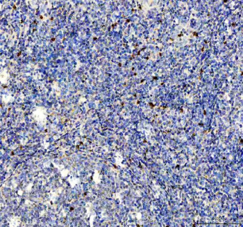 IHC staining of FFPE human tonsil tissue with Interleukin-2 antibody, HRP-labeled secondary and DAB substrate. HIER: boil tissue sections in pH8 EDTA for 20 min and allow to cool before testing.