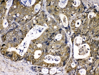 Cyclophilin A Antibody Intestinal Cancer IHC. Immunohistochemical staining of FFPE human intestinal cancer tissue using Cyclophilin A Antibody / Protein Folding Chaperone Antibody demonstrates strong cytoplasmic HRP-DAB brown staining within malignant epithelial cells. The staining pattern is consistent with expression of Cyclophilin A (PPIA), a peptidyl-prolyl cis-trans isomerase that functions as a molecular chaperone involved in protein folding, cellular stress responses, and signal transduction. Positive immunoreactivity throughout the tumor cell population highlights the widespread expression of Cyclophilin A in metabolically active cells and supports its role in maintaining protein homeostasis under conditions of rapid growth and cellular remodeling. Required HIER: steam section in pH6 citrate buffer for 20 min and allow to cool prior to testing.