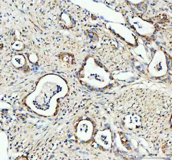 Bcl-XL Antibody Pancreatic Cancer IHC. Immunohistochemistry staining of FFPE human pancreatic cancer tissue using Bcl-XL Antibody / Anti-Apoptotic Protein Antibody demonstrates cytoplasmic and membranous HRP-DAB brown staining within malignant epithelial cells forming glandular tumor structures. The staining pattern is consistent with expression of Bcl-XL, the major anti-apoptotic protein encoded by the BCL2L1 gene. Bcl-XL functions as a key regulator of mitochondrial apoptosis by inhibiting pro-apoptotic BCL2 family members and promoting cellular survival under conditions of stress. Expression of Bcl-XL is frequently investigated in cancer biology due to its association with tumor cell survival, apoptosis resistance, and therapeutic response. HIER was performed by boiling tissue sections in pH 8 EDTA buffer for 20 minutes followed by cooling prior to immunostaining. HRP-conjugated secondary antibody and DAB chromogen were used for signal detection.