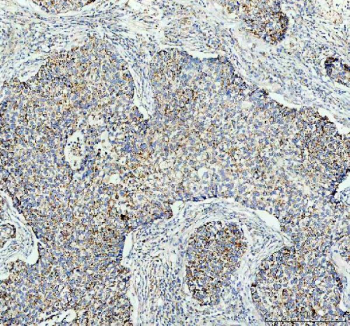 IHC testing of FFPE human lung cancer tissue with GAS6 antibody at 1ug/ml. Required HIER: steam section in pH8 EDTA buffer for 20 min and allow to cool prior to testing.