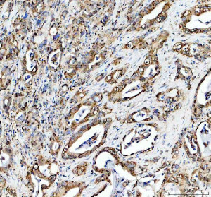 HFE Antibody Human Pancreatic Cancer IHC. Immunohistochemical analysis of FFPE human pancreatic cancer tissue following heat-induced epitope retrieval in pH8 EDTA buffer. Tissue sections were incubated with HFE Antibody at 2 ug/ml overnight, followed by an HRP-conjugated secondary antibody and DAB chromogen for visualization. Moderate membranous and cytoplasmic staining is observed in the neoplastic epithelial cells, consistent with the localization of HFE as a membrane-associated regulator of iron homeostasis. This staining pattern demonstrates that this HFE Antibody, a Hereditary Hemochromatosis Protein Antibody, is suitable for detecting endogenous HFE expression in human FFPE pancreatic cancer tissue by immunohistochemistry.