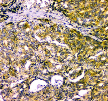 Immunohistochemical staining using NARG1 antibody on paraffin-embedded human gastric cancer tissue sections. Heat-induced epitope retrieval was performed using EDTA buffer (pH 8.0) prior to antibody incubation. Sections were blocked with 10% goat serum and incubated with NARG1 antibody overnight at 4C. Detection was carried out using an HRP-based secondary system with DAB as the chromogen. Staining demonstrates cytoplasmic immunoreactivity in tumor cells. Nuclei were counterstained with hematoxylin.