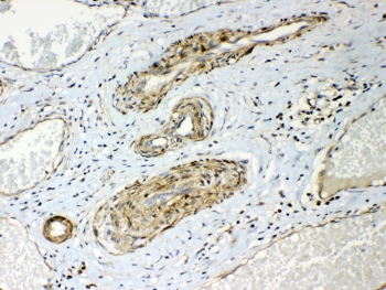 HSP22 Antibody Human Lung Cancer IHC. Immunohistochemistry staining of FFPE human lung cancer tissue with HSP22 Antibody at 1 ug/ml. HIER was performed by steaming tissue sections in pH 6 citrate buffer for 20 minutes prior to staining. The tissue section was incubated with HSP22 antibody, followed by HRP-conjugated secondary antibody and DAB chromogen detection. HSP22 Antibody / Small Heat Shock Protein Antibody demonstrates cytoplasmic staining in lung cancer cells and supports studies of HSPB8 expression, molecular chaperone activity, protein quality control and cellular stress response pathways.