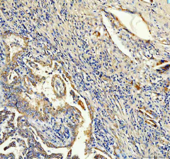 Immunohistochemical staining of FFPE human lung cancer tissue with ANGPTL2 antibody, HRP-secondary and DAB substrate. HIER: boil tissue sections in pH8 EDTA for 20 min and allow to cool before testing.