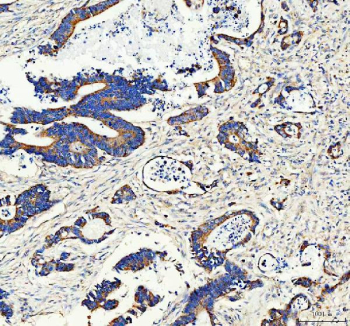 Immunohistochemical staining of FFPE human colon cancer tissue with ANGPTL2 antibody, HRP-secondary and DAB substrate. HIER: boil tissue sections in pH8 EDTA for 20 min and allow to cool before testing.