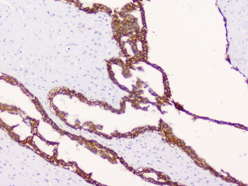 Beta-Catenin Antibody Breast Cancer Tissue IHC. Immunohistochemistry analysis of FFPE human breast cancer tissue using Beta-Catenin antibody shows strong membranous staining outlining tumor epithelial cells, consistent with CTNNB1 / Catenin beta-1 localization at adherens junctions, with mild cytoplasmic signal in select cells. Tumor glandular structures are clearly defined, while surrounding stromal regions display comparatively low staining. Hematoxylin counterstain provides nuclear contrast and tissue architecture. HIER: steam FFPE sections in pH 6 citrate buffer for 20 min and allow to cool prior to testing.