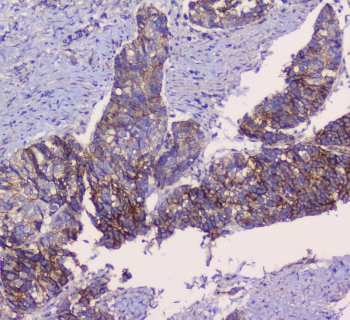 Beta-Catenin Antibody Prostate Cancer Tissue IHC. Immunohistochemistry analysis of FFPE human prostate cancer tissue using Beta-Catenin antibody shows strong membranous and cytoplasmic staining in tumor epithelial cells, consistent with CTNNB1 / Catenin beta-1 localization, with heterogeneous intensity across tumor regions. Malignant glandular structures are well delineated, while surrounding stromal tissue displays comparatively low staining. Hematoxylin counterstain provides clear nuclear contrast and architectural detail. HIER: steam FFPE sections in pH 6 citrate buffer for 20 min and allow to cool prior to testing.