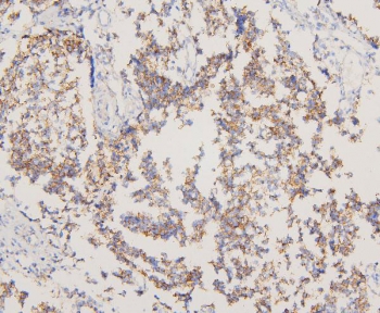 EGFR Antibody Human Glioma IHC. Immunohistochemistry staining of FFPE human glioma with EGFR antibody. HIER: boil tissue sections in pH6, 10mM citrate buffer, for 20 min and allow to cool before testing.