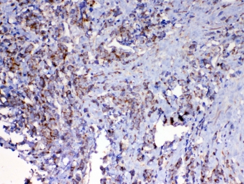 IHC testing of FFPE human lung cancer tissue with MAVS antibody at 1ug/ml. Required HIER: steam section in pH6 citrate buffer for 20 min and allow to cool prior to testing.