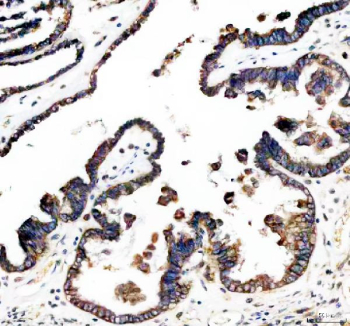 IHC staining of FFPE human ovarian tissue with CD47 antibody, HRP-secondary and DAB substrate. HIER: boil tissue sections in pH8 EDTA for 20 min and allow to cool before testing.