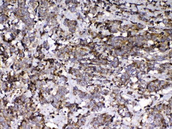 VDBP Antibody Lung Cancer IHC. Immunohistochemistry analysis of FFPE human lung cancer tissue stained with VDBP antibody demonstrates diffuse granular cytoplasmic HRP-DAB brown staining throughout tumor-associated epithelial cellular populations, consistent with the role of Vitamin D binding protein / VDBP in circulating transport physiology and systemic metabolic regulation pathways. The observed staining profile aligns with the secretory biology of this vitamin D-associated carrier protein. Required HIER: steam tissue sections in pH 6 citrate buffer for 20 min and allow to cool prior to testing.