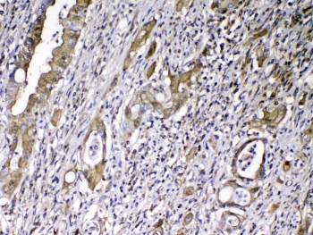 VDBP Antibody Rectal Cancer IHC. Immunohistochemistry analysis of FFPE human rectal cancer tissue stained with VDBP antibody demonstrates granular cytoplasmic HRP-DAB brown staining within gland-forming tumor epithelial cellular populations, consistent with expression of Vitamin D binding protein / VDBP in circulating transport and metabolic homeostasis-associated pathways. The observed staining profile aligns with the secretory biology of this vitamin D-associated serum carrier protein within epithelial-derived tumor tissue. Required HIER: steam tissue sections in pH 6 citrate buffer for 20 min and allow to cool prior to testing.