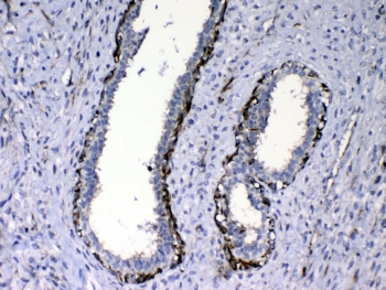 IHC testing of FFPE human breast cancer tissue with CCN3 antibody at 1ug/ml. Required HIER: steam section in pH6 citrate buffer for 20 min and allow to cool prior to testing.
