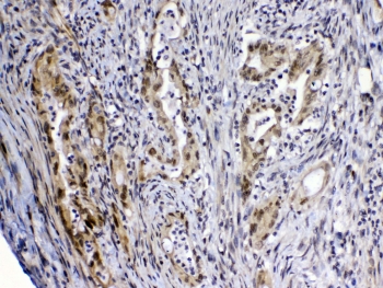 IHC testing of FFPE human rectal cancer tissue with MED4 antibody at 1ug/ml. Required HIER: steam section in pH6 citrate buffer for 20 min and allow to cool prior to testing.