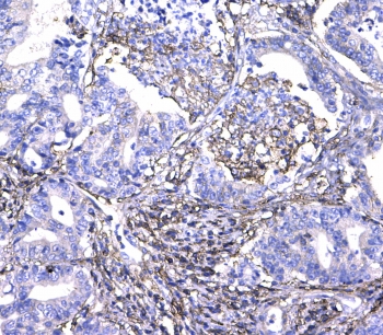 CD44 Antibody Colon Cancer IHC. Immunohistochemistry analysis of CD44 / CD44 antigen expression in FFPE human colon cancer tissue using rabbit polyclonal antibody at 1 ug/ml. Membranous HRP-DAB brown staining is observed in tumor epithelial cells, outlining cell borders and highlighting cell surface localization consistent with CD44 expression. The staining pattern demonstrates heterogeneous intensity across tumor regions and supports its use for evaluating CD44 distribution, tumor cell organization, and microenvironment-associated expression in colorectal carcinoma tissue. Heat induced epitope retrieval was performed by steaming tissue sections in pH 6 citrate buffer for 20 min followed by cooling prior to testing.
