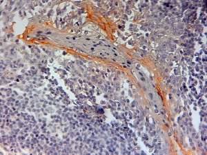 NLRP3 Antibody Tonsil Tissue Immunohistochemistry. IHC testing of FFPE human tonsil with NLRP3 antibody at 2ug/ml. HIER: steamed with pH6 citrate buffer, HRP-staining.