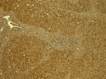 IHC testing of FFPE human liver tissue with STAT3 antibody at 7ug/ml. HIER: steamed with pH9 Tris/EDTA buffer, HRP-staining.