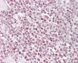 IKZF1 Antibody Human Tonsil AP-IHC. Immunohistochemical staining of FFPE human tonsil tissue using IKZF1 Antibody demonstrates prominent nuclear AP-red staining within subsets of lymphoid cells. The staining pattern is consistent with expression of IKZF1 (Ikaros Family Zinc Finger 1), a DNA-binding transcription factor that functions as a master regulator of lymphoid development, hematopoietic differentiation, and immune cell lineage commitment. Strong nuclear immunoreactivity is expected for this transcriptional regulator and highlights its essential role in controlling gene expression programs required for normal lymphocyte maturation and immune system function. HIER: steamed in pH 6 citrate buffer prior to staining. Detection was performed using an alkaline phosphatase (AP) chromogenic method.