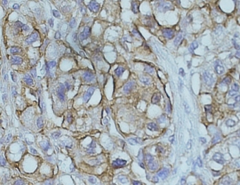 IHC staining of FFPE human hepatocelluar carcinoma with NDRG1 antibody at 0.5ug/ml. 