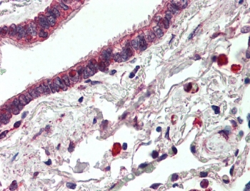 HER3 Antibody Lung IHC. Immunohistochemistry testing of FFPE human lung tissue with HER3 antibody at 5ug/ml. Steamed antigen retrieval with citrate buffer pH 6, AP-staining.