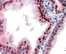 IHC staining of FFPE human prostate with p27Kip1 antibody at 5ug/ml. HIER: steamed with pH6 citrate buffer, AP-staining.
