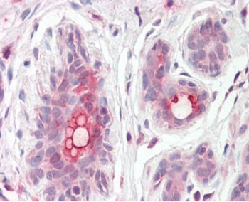 IHC testing of FFPE human breast tissue with MRP8 antibody at 3.75ug/ml. Required HIER: steamed antigen retrieval with pH6 citrate buffer; AP-staining.