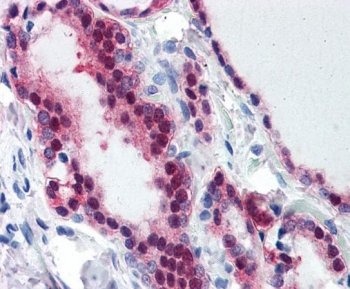 IHC staining of FFPE human thyroid tissue with TIA1 antibody at 3.75ug/ml. Required HIER: steamed antigen retrieval with pH6 citrate buffer; AP-staining.