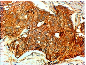 HER2 Antibody Breast Carcinoma Membrane IHC. Immunohistochemistry analysis of FFPE human HER2-positive breast carcinoma tissue using HER2 Antibody demonstrates intense, continuous HRP-DAB brown membranous staining surrounding tumor cell clusters, highlighting high receptor density at the cell surface consistent with ErbB2 / HER2 amplification, while adjacent stromal components show minimal background; nuclei are counterstained blue. HIER: steamed sections in pH 6 citrate buffer followed by HRP-based detection.