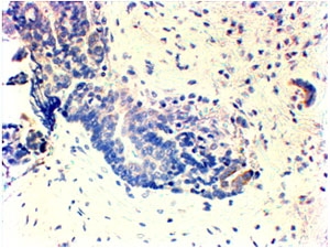HER2 Antibody TNBC Negative IHC. Immunohistochemistry analysis of FFPE human triple negative breast carcinoma tissue using HER2 Antibody shows absence of HRP-DAB brown membranous staining in tumor epithelial cells, consistent with lack of ErbB2 / HER2 expression in TNBC, while background stromal tissue remains largely unstained; nuclei are counterstained blue. HIER: steamed sections in pH 6 citrate buffer followed by HRP-based detection.