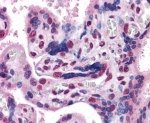 GBX2 Antibody Placenta IHC. Immunohistochemistry analysis of FFPE human placenta tissue stained with GBX2 Antibody / Developmental Patterning Protein Antibody demonstrates prominent nuclear AP-blue staining within trophoblast-associated cellular populations, consistent with the role of Gastrulation brain homeobox 2 / GBX2 in embryonic development and tissue differentiation-associated transcriptional regulation. The observed nuclear localization pattern aligns with the established function of GBX2 as a developmental homeobox transcription factor involved in embryonic patterning pathways. HIER: steamed with pH 6 citrate buffer. AP-based detection chemistry was used for visualization.