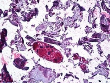 DGAT1 Antibody Human Colon IHC. IHC staining of FFPE human colon tissue with DGAT1 antibody demonstrated strong cytoplasmic staining in glandular epithelial cells, consistent with the role of DGAT1 (Diacylglycerol O-Acyltransferase 1) in triglyceride synthesis and intestinal lipid metabolism. DGAT1 is highly expressed in enterocytes, where it catalyzes the final step of triglyceride biosynthesis and facilitates dietary fat absorption. The prominent epithelial staining observed in the colon is in agreement with the established involvement of DGAT1 in neutral lipid storage and energy homeostasis. Staining was performed using an alkaline phosphatase detection system. Heat-induced epitope retrieval was achieved by steaming tissue sections in pH 6 citrate buffer before immunostaining with DGAT1 antibody at 3.75 ug/ml.