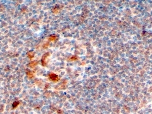 ZCCHC11 Antibody Lymph Node IHC. Immunohistochemistry analysis of FFPE human lymph node tissue stained with ZCCHC11 antibody at 4 ug/ml. Following HIER in pH 6 citrate buffer, scattered HRP-DAB brown cytoplasmic staining is observed in subsets of lymphoid cells, consistent with expression of ZCCHC11 / TUT4, a terminal uridylyl transferase involved in miRNA processing and post-transcriptional RNA regulation.