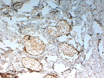 IHC staining of FFPE human breast cancer with FOXC2 antibody at 2ug/ml. HIER: steamed with pH6 citrate buffer, HRP-staining.