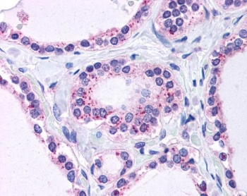 IHC testing of FFPE human thyroid tissue with RPL22 antibody at 3.75ug/ml. HIER: steamed with pH6 citrate buffer, AP-staining.