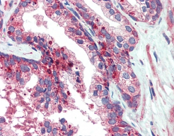 IHC testing of FFPE human prostate tissue with VPS35 antibody at 5ug/ml. Required HIER: steamed antigen retrieval with pH6 citrate buffer; AP-staining.