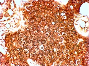 HER2 Antibody HER2-Positive Breast Cancer IHC. Immunohistochemistry analysis of FFPE human HER2-positive breast carcinoma tissue using HER2 / ERBB2 antibody demonstrates strong, diffuse HRP-DAB brown membranous staining in tumor epithelial cells, consistent with ErbB2 / HER2 overexpression as a receptor tyrosine kinase, while surrounding stromal tissue shows minimal signal; nuclei are counterstained blue. HIER: steamed sections in pH 6 citrate buffer followed by HRP-based detection.
