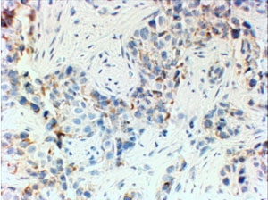 HER2 Antibody Triple Negative Breast Cancer IHC. Immunohistochemistry analysis of FFPE human triple negative breast cancer (TNBC) tissue using HER2 / ERBB2 Antibody shows no detectable HRP-DAB staining in tumor epithelial cells, consistent with lack of ErbB2 / HER2 expression in TNBC, while surrounding stromal elements remain negative; nuclei are counterstained blue. HIER: steamed sections in pH 6 citrate buffer followed by HRP-based detection.