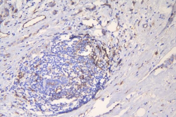 IHC staining of FFPE human brest cancer with ICAM1 antibody. HIER: boil tissue sections in pH8 EDTA for 20 min and allow to cool before testing.