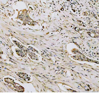 DNMT1 Antibody Breast Cancer Tissue IHC. Immunohistochemistry analysis of FFPE human breast carcinoma tissue using DNMT1 Antibody shows nuclear HRP-DAB brown staining in tumor epithelial cells, consistent with localization of DNMT1 / DNA methyltransferase 1 as a nuclear epigenetic regulator. Staining intensity varies across tumor regions, with positive nuclei distributed within malignant cell populations, while surrounding stromal elements display lower signal. Hematoxylin counterstain provides nuclear contrast and tissue architecture. HIER: boil FFPE tissue sections in pH 8 EDTA for 20 min and allow to cool before testing.