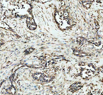 DNMT1 Antibody Pancreatic Cancer Tissue IHC. Immunohistochemistry analysis of FFPE human pancreatic carcinoma tissue using DNMT1 Antibody shows nuclear HRP-DAB brown staining in tumor epithelial cells, consistent with localization of DNMT1 / DNA methyltransferase 1 as a nuclear epigenetic regulator. Positive nuclei are observed within malignant glandular structures, while surrounding stromal regions display lower staining intensity. Hematoxylin counterstain provides nuclear contrast and tissue architecture. HIER: boil FFPE tissue sections in pH 8 EDTA for 20 min and allow to cool before testing.