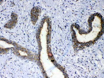 ERBB4 Antibody Breast Cancer IHC. Immunohistochemistry of ERBB4 antibody in human breast cancer tissue. FFPE human breast carcinoma sections were subjected to heat-induced epitope retrieval by steaming in pH 6 citrate buffer for 20 minutes followed by cooling prior to staining. The ERBB4 antibody was applied at 1 ug/ml as the detecting antibody. HRP-DAB brown staining is observed predominantly along the membranous borders and within the cytoplasm of malignant glandular epithelial cells, while surrounding stromal elements exhibit lower background staining. The staining pattern is consistent with HER4 expression in breast carcinoma tissue.