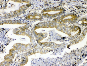 ERBB4 Antibody Colon Cancer IHC. Immunohistochemistry testing of FFPE human colon cancer tissue with ERBB4 antibody at 1ug/ml. Required HIER: steam section in pH6 citrate buffer for 20 min and allow to cool prior to testing.