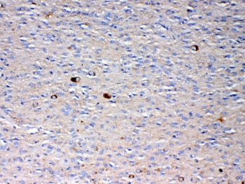 IHC testing of FFPE human glioma with NSF antibody at 1ug/ml. Required HIER: steam section in pH6 citrate buffer for 20 min and allow to cool prior to testing.