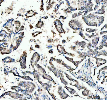 IHC staining of FFPE human lung cancer tissue with OGG1 antibody. HIER: boil tissue sections in pH8 EDTA for 20 min and allow to cool before testing.