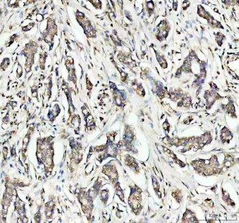 IHC staining of FFPE human breast cancer tissue with OGG1 antibody. HIER: boil tissue sections in pH8 EDTA for 20 min and allow to cool before testing.